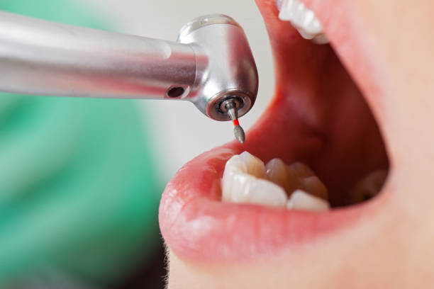Best Emergency Treatment for Dental Infections or Abscesses in Pensacola, FL